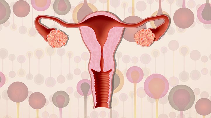 A Comprehensive Overview of Polycystic Ovarian Syndrome (PCOS)