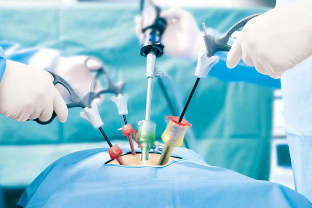 Laparoscopic Surgery Benefits: Your Faster, Gentler Recovery in Bengaluru.